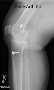 Preoperative X-ray showing the AP and lateral views of the right knee with retained screws consistent with ACL reconstruction - img 2