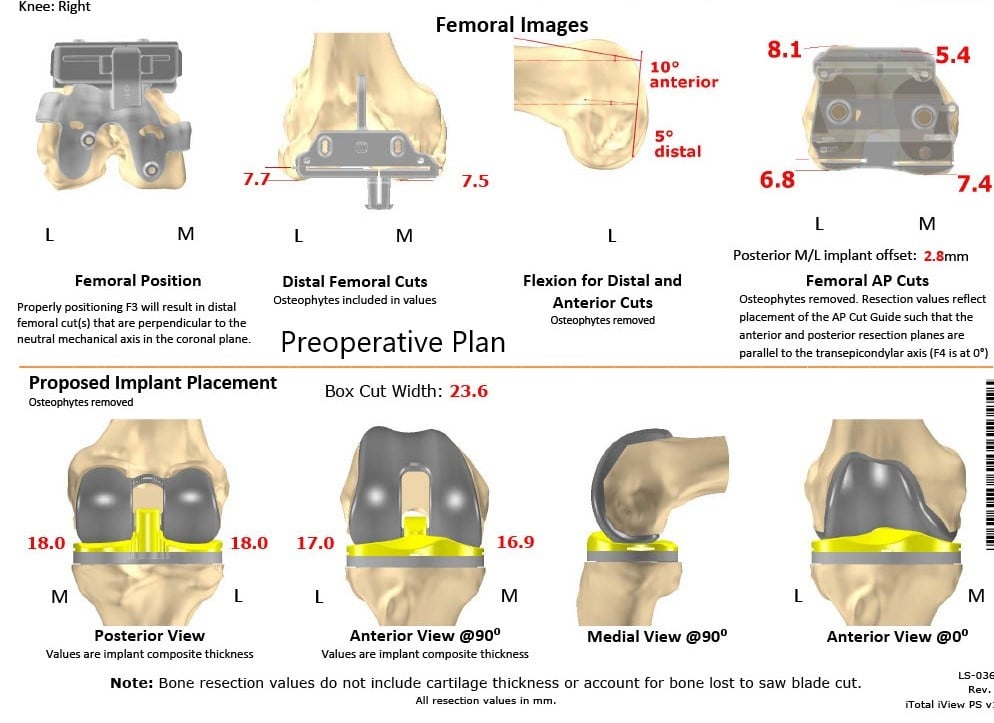 Complete Orthopedics patient specific surgical plan for a Custom Right Total Knee Replacement in a 55-year-old Female with Prior ACL Reconstruction - scan 2