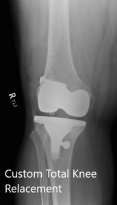 Postoperative images showing AP and lateral views of the right knee
