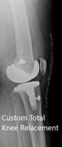 Postoperative images showing AP and lateral views of the right knee - img 2
