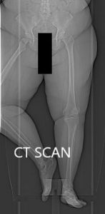 Topographic CT images of the weight-bearing Right and Left knee respectively