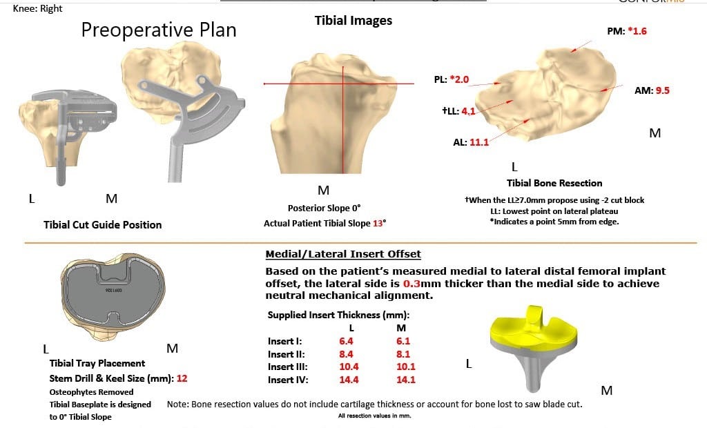 Complete Orthopedics patient specific surgical plan for a Customized Bilateral Knee Replacement in a 78-year-old male
