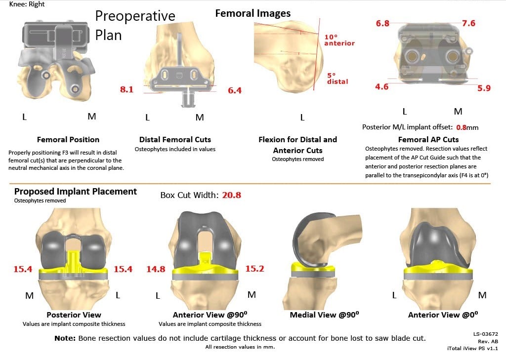 Complete Orthopedics patient specific surgical plan for a Customized Bilateral Knee Replacement in a 78-year-old male - scan 2