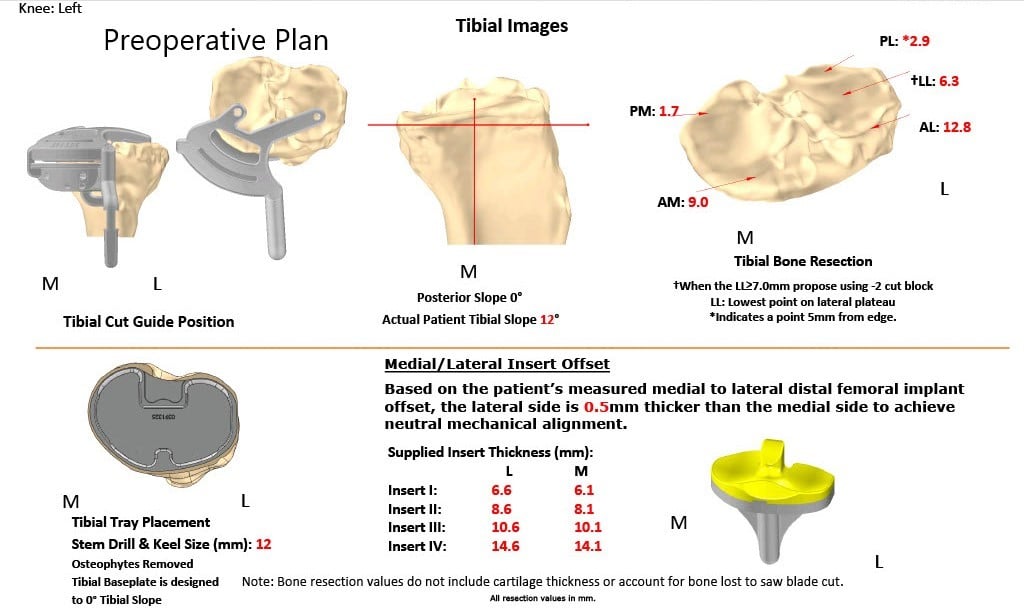 Complete Orthopedics patient specific surgical plan for a Customized Bilateral Knee Replacement in a 78-year-old male - scan 3