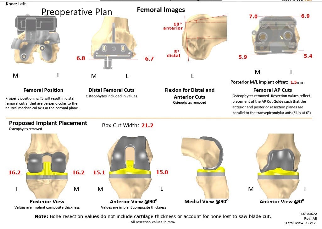 Complete Orthopedics patient specific surgical plan for a Customized Bilateral Knee Replacement in a 78-year-old male - scan 4