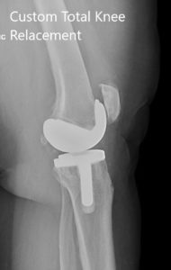 Postoperative X-ray showing the lateral views of both knees