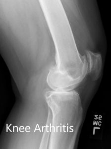 Preoperative X-ray of the left knee showing AP and lateral views - img 2
