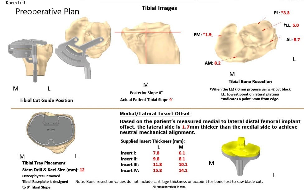 Plan quirúrgico completo específico para pacientes de Ortopedia para un reemplazo total personalizado de la rodilla izquierda en una mujer de 66 años