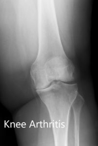 Preoperative X-ray showing the AP and lateral views of the left knee
