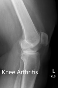 Preoperative X-ray showing the AP and lateral views of the left knee - img 2