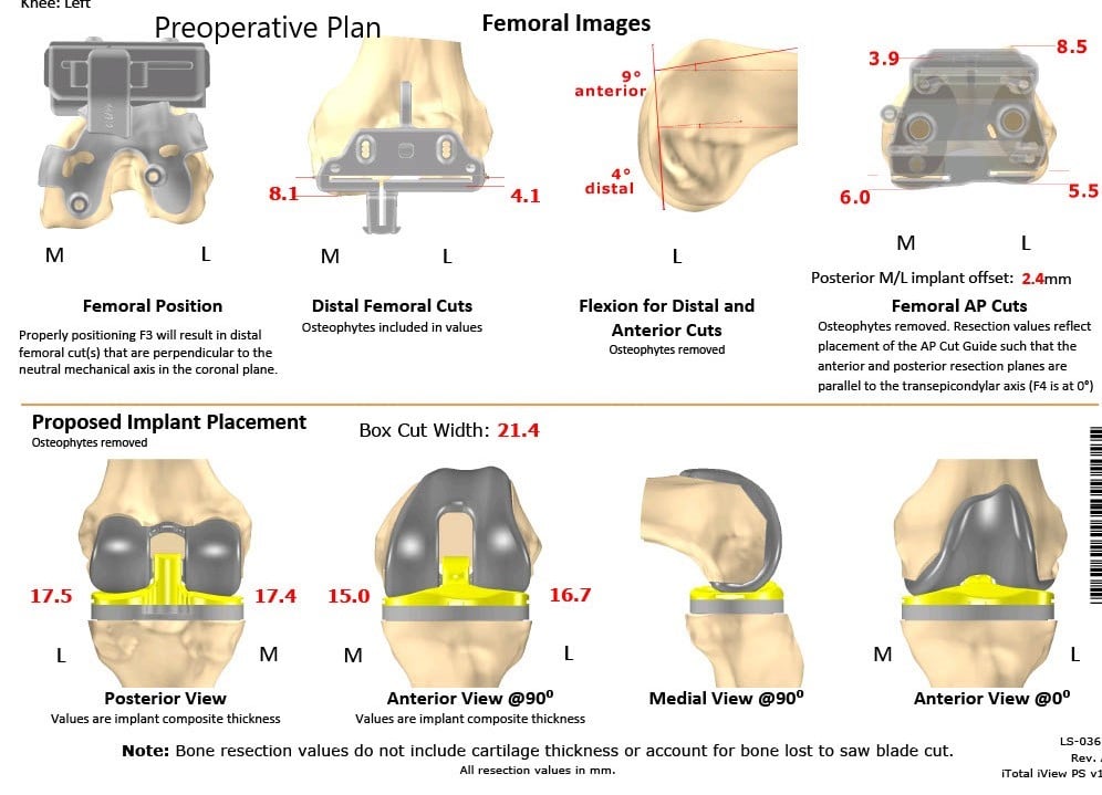 Complete Orthopedics patient specific surgical plan for a Customized Left Total Knee Replacement in a 73-year-old Male - scan 2