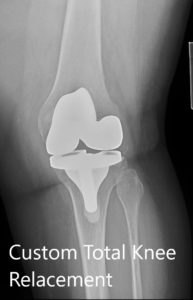 Postoperative X-ray showing the AP and lateral view of the left knee