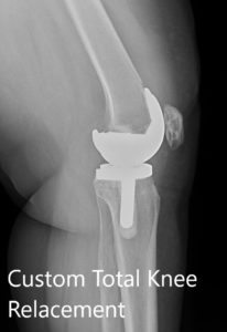 Postoperative X-ray showing the AP and lateral view of the left knee -img 2