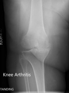 Preoperative X-ray of the right knee showing AP and lateral views