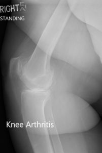 Preoperative X-ray of the right knee showing AP and lateral views - img 2