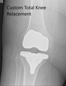 Postoperative x-ray images showing AP and lateral views of the right knee