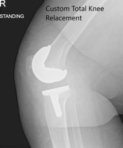 Postoperative x-ray images showing AP and lateral views of the right knee - img 2