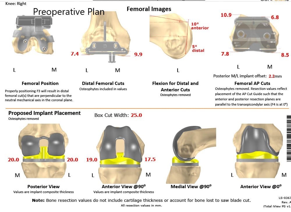 Complete Orthopedics patient specific surgical plan for a Customized Right Knee Replacement in a 65-year-old female - scan 2