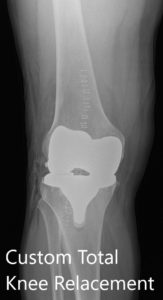 Postoperative X-ray showing AP and lateral views of the right knee