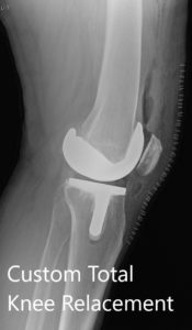 Postoperative X-ray showing AP and lateral views of the right knee - img 2