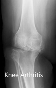 Preoperative X-ray of the right knee showing AP and lateral views