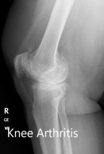 Preoperative X-ray of the right knee showing AP and lateral views - img 2