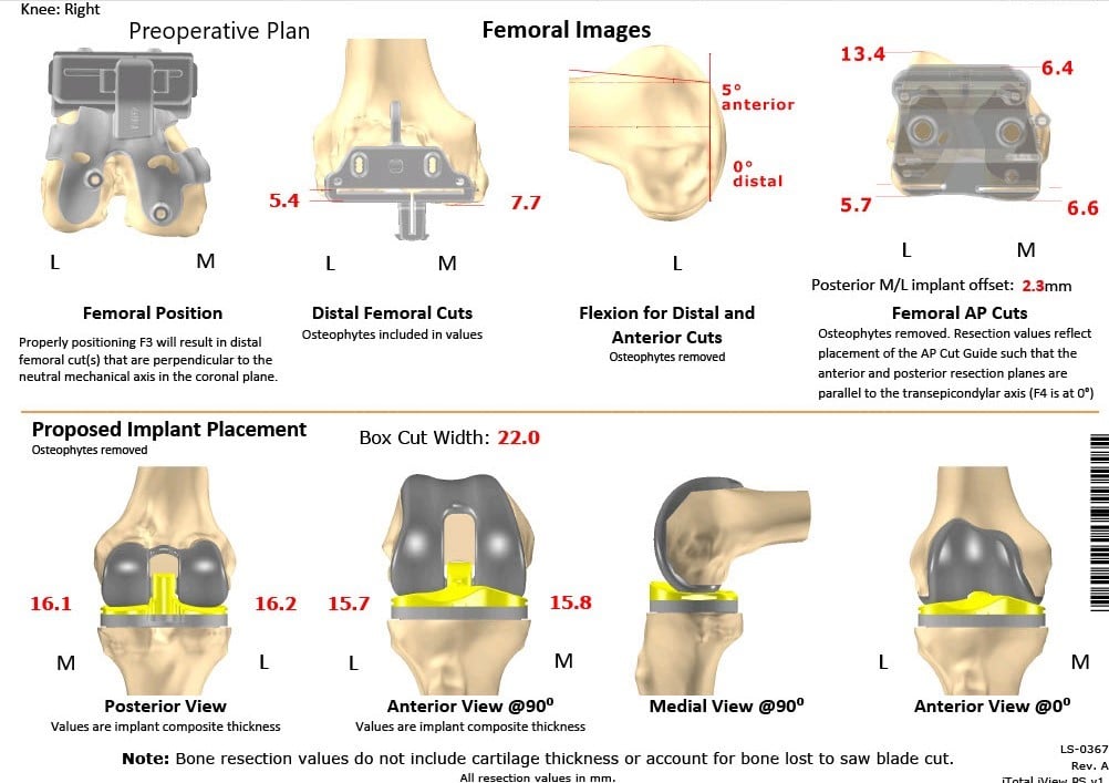 Complete Orthopedics patient specific surgical plan for a Customized Right Total Knee Replacement in a 73-year-old Male with Arthritis