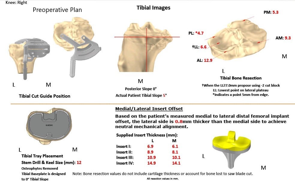 Complete Orthopedics patient specific surgical plan for a Customized Right Total Knee Replacement in a 73-year-old Male with Arthritis - scan 2