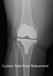 Postoperative X-ray of the right knee showing AP and lateral views
