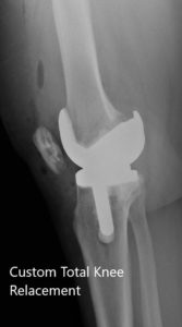 Postoperative X-ray of the right knee showing AP and lateral views - img 2