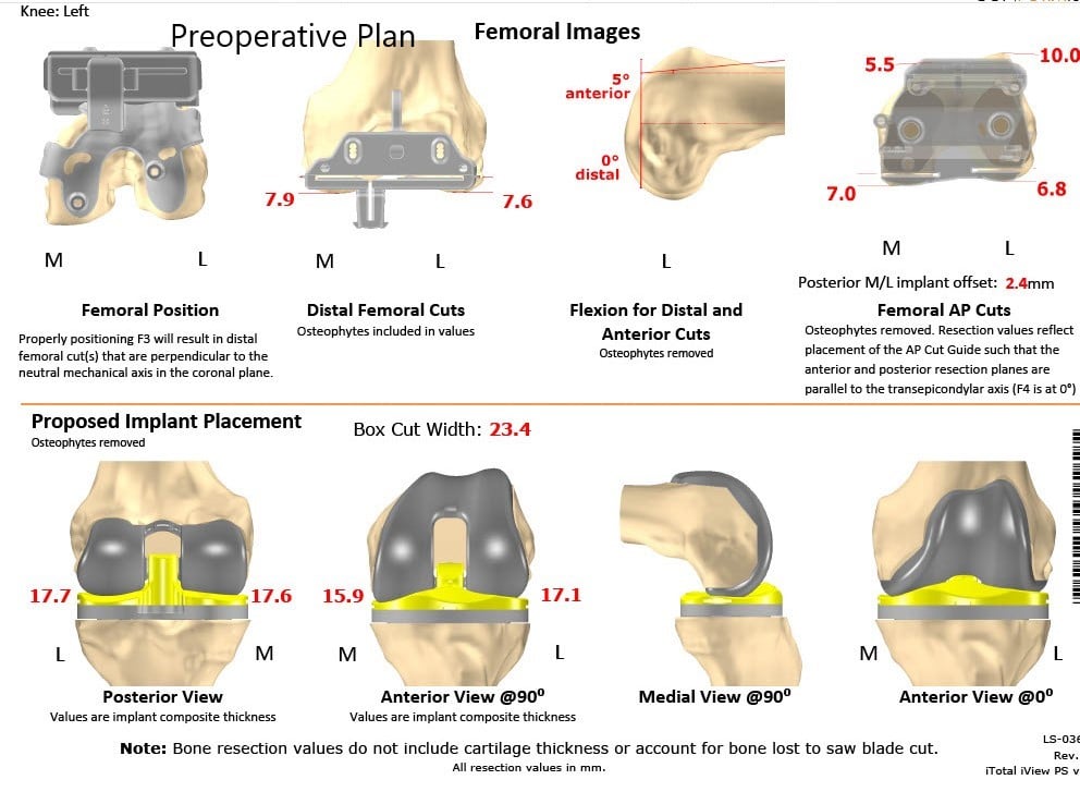 Complete Orthopedics patient specific surgical plan for a Left Custom Total Knee Replacement in a 74-year-old female - scan 2