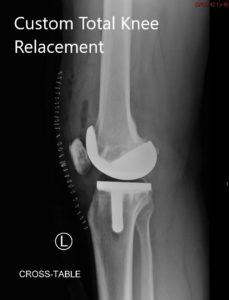 Postoperative X-ray of the left knee showing lateral and AP views