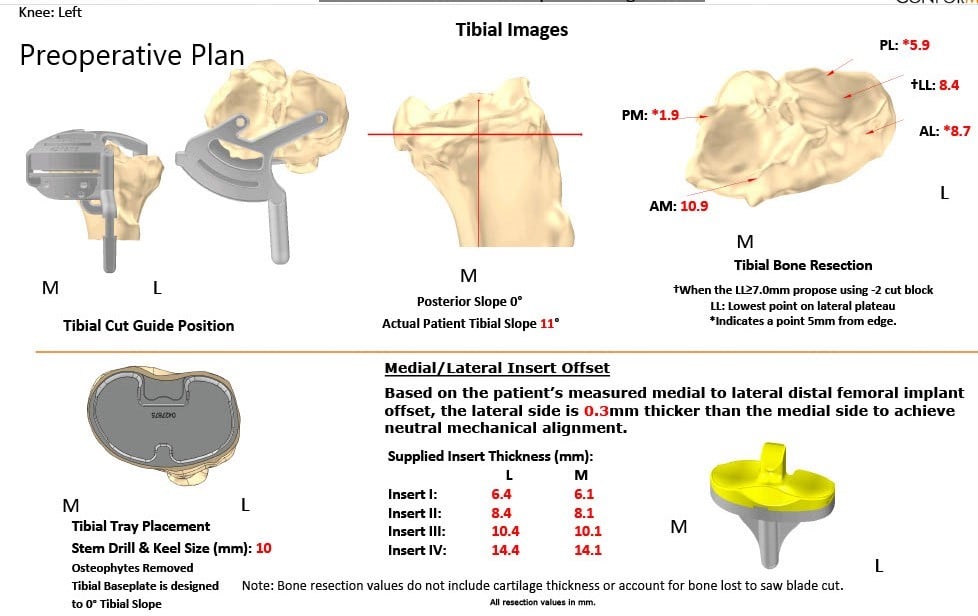 Complete Orthopedics patient specific surgical plan for a Left Customized Knee Replacement in an 80-year-old male