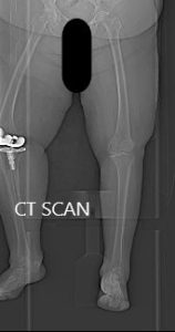 Topogram image of the patients lower extremities, suggesting severe tricompartmental osteoarthritis of the left knee