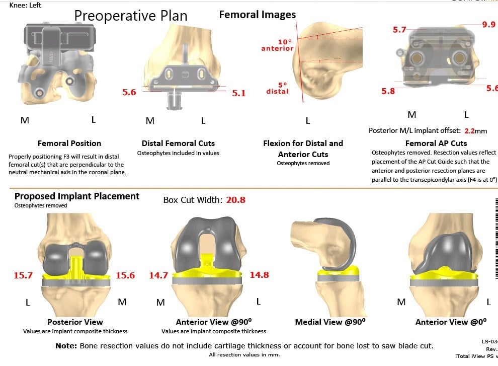 Complete Orthopedics patient specific surgical plan for a Left Customized Knee Replacement in an 80-year-old male - scan 2