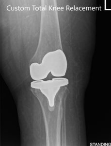 Postoperative X-ray showing AP and lateral images of the left knee
