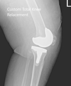 Postoperative X-ray showing AP and lateral images of the left knee - img 2