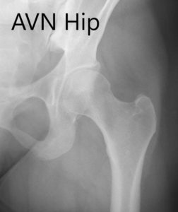 Anteroposterior view of the left hip showing pre-collapse avascular necrosis of the left hip.