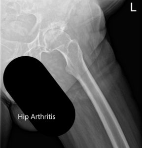 Preoperative X-ray showing the frog-legged lateral and AP view of the left hip