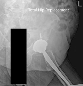 Postoperative X-ray of the Pelvis and lateral view of the left hip - img 2