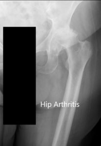 Preoperative X-ray of the left hip showing AP and lateral views