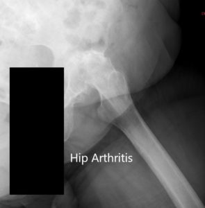 Preoperative X-ray of the left hip showing AP and lateral views - img 2
