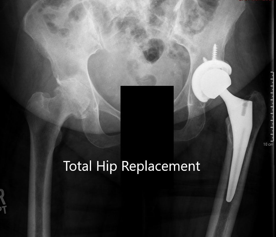 https://www.cortho.org/wp-content/uploads/2020/02/LeftTotalHipReplacement3.jpg