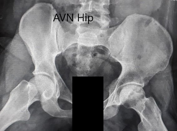 Preoperative X-ray of the pelvis with both hips in the frog-legged lateral view showing AVN of the Left Hip