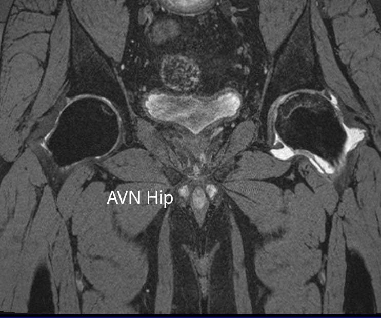 T2WI coronal section of MRI showing AVN hip