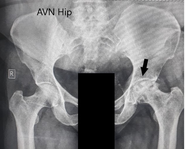 Preoperative X-ray of the pelvis with both hips in anteroposterior view showing AVN changes in the left hip