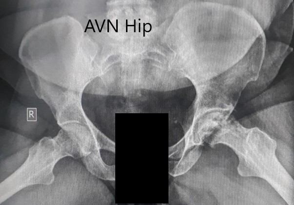 Preoperative X-ray of the pelvis with both hips in the frog-legged lateral view showing AVN changes in the left hip