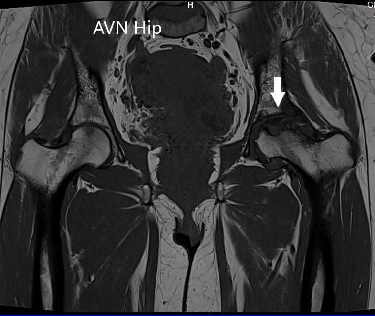 T1WI image of MRI showing the coronal section