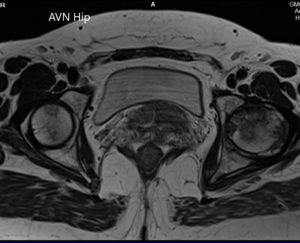 T1WI of the MRI showing an axial section of the bilateral femoral head