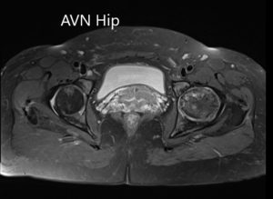 T2WI of the MRI showing an axial section of the bilateral femoral head
